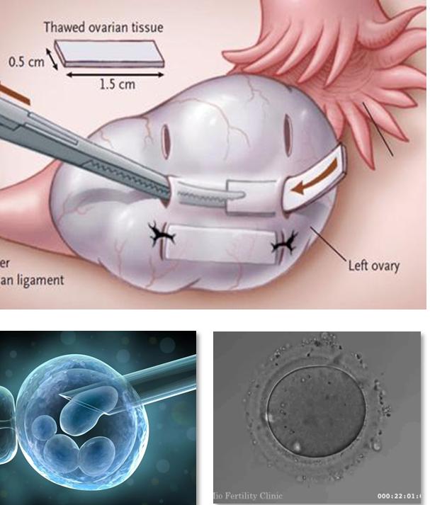 助您好孕的胚胎冷冻技术