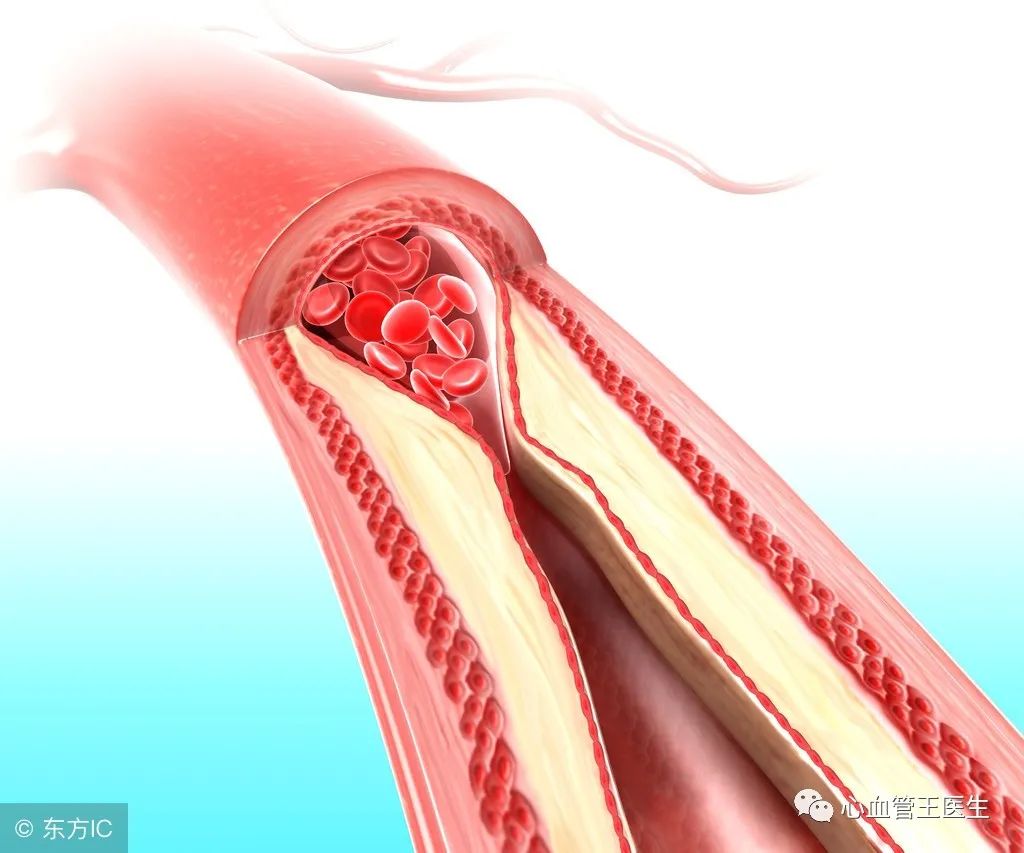 心血管医生告诉您如何从生活中的一点一滴预防心脑血管疾病