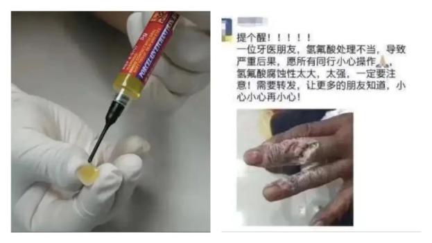 氢氟酸本身具有强腐蚀性,能强烈地腐蚀金属,玻璃和含硅的物体,如吸入