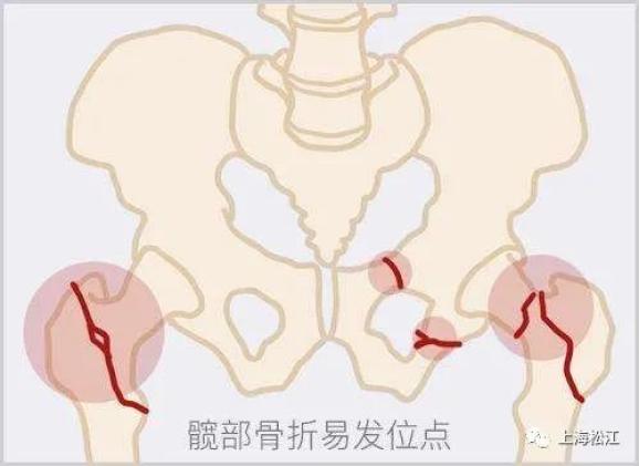 因為發生部位在股骨靠近身體中心的位置,所以又稱為股骨近端骨折.