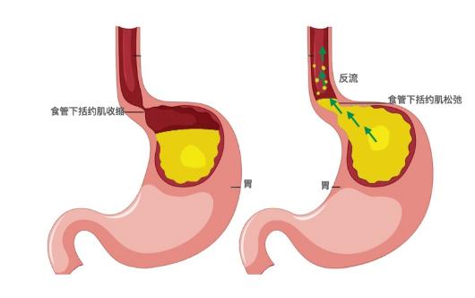 反酸燒心咳嗽可能是反流性食管炎在作祟