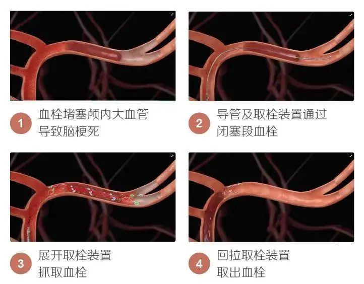 脑动脉支架取栓创造生命奇迹浅析脑动脉取栓一