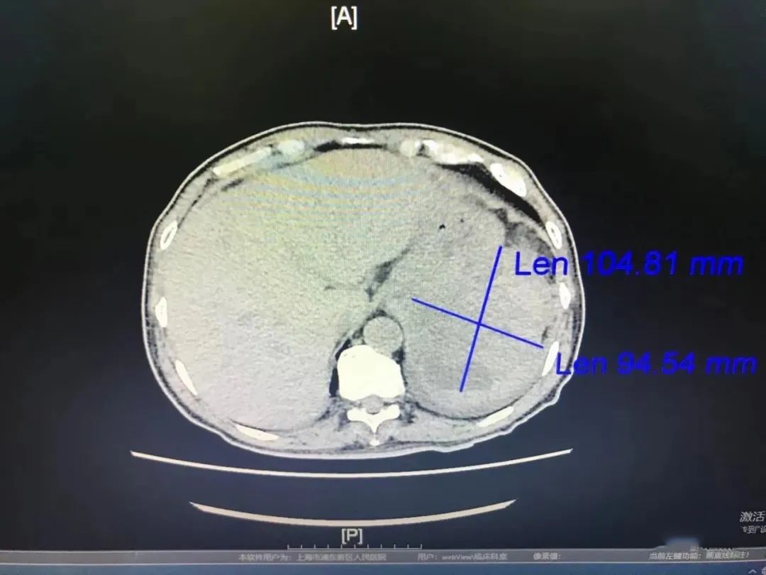 【浦人医·医者】一例胃间质瘤引发的思考