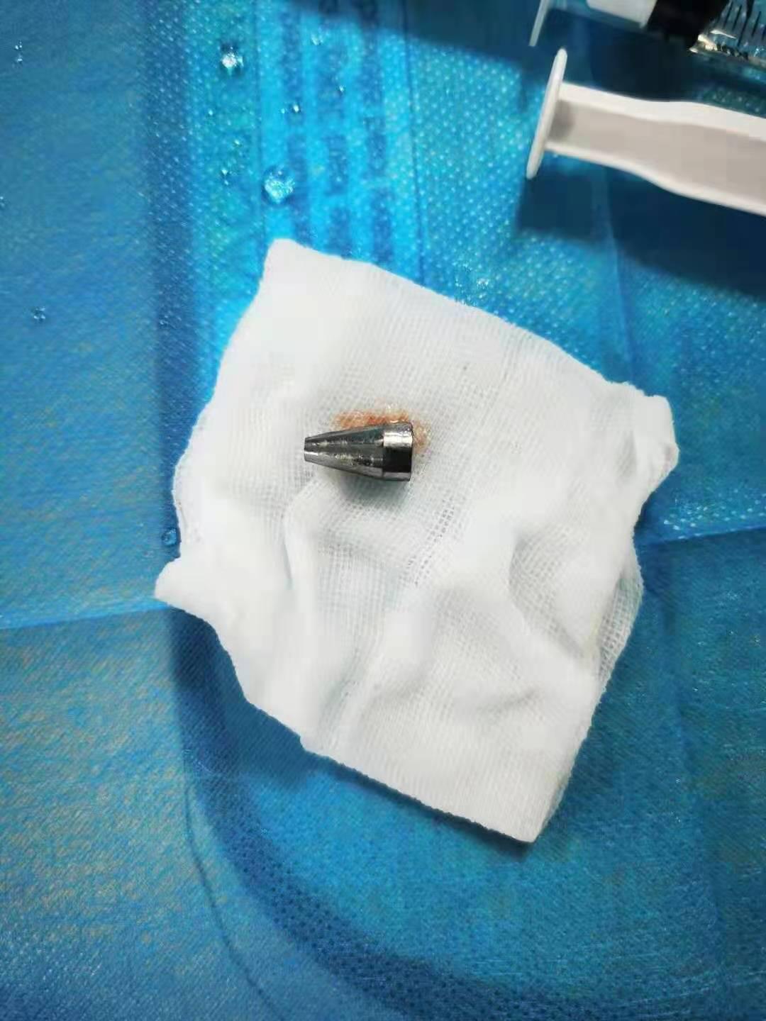 小孩咳嗽不停,医生竟从气管里取出