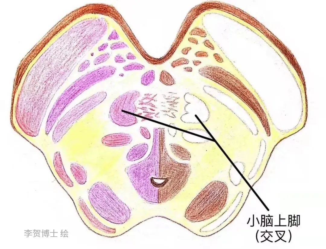 圖4:中腦wernekink連合解剖圖5:中腦橫斷面wernekink連合解剖2.