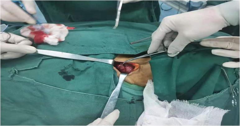 我院甲乳外科任东伟主任团队完成甲状旁腺腺瘤导致的原发性甲状旁腺