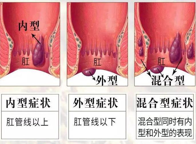 初期痔疮男人图片