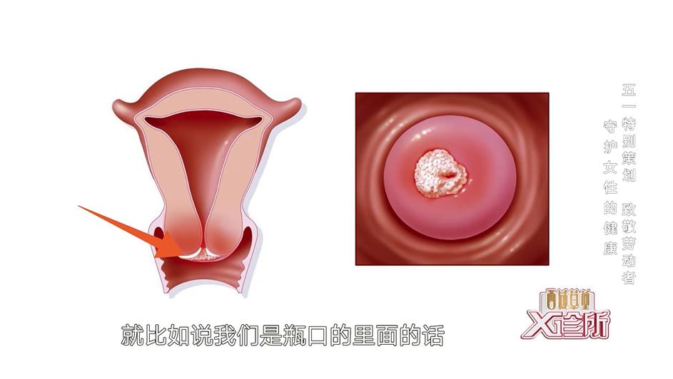 早期会有前面我们看见的出血症状,而如果是发生在宫颈管里,早期不会有