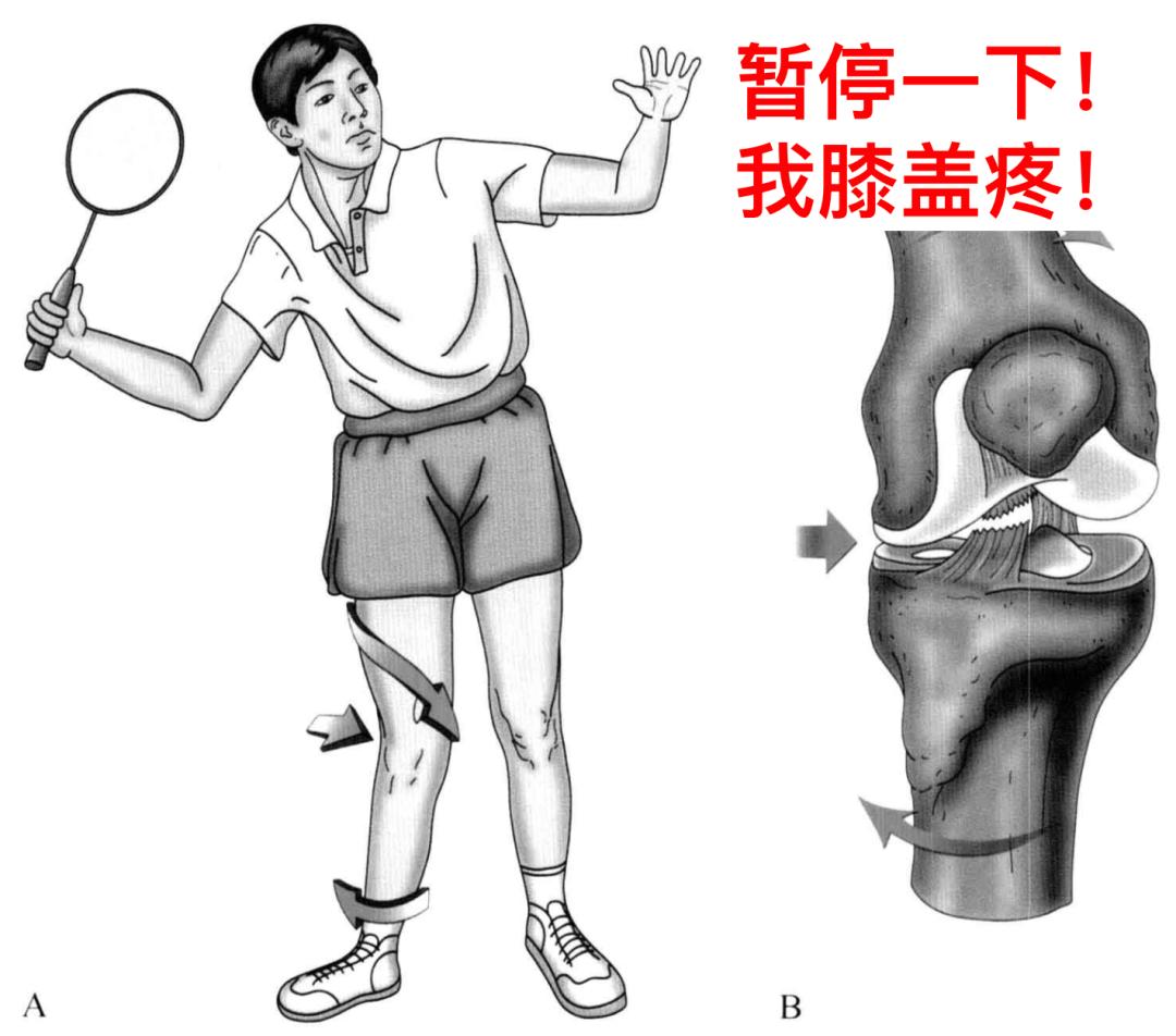 典型的前交叉韌帶損傷機制