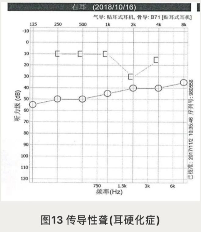 耳声发射图怎么看【华东｜特色诊疗】耳鼻咽喉科：“五种检查”测听力！科学诊断耳背原因_https://www.jmylbn.com_新闻资讯_第3张