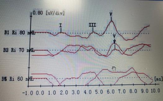 耳声发射图怎么看【华东｜特色诊疗】耳鼻咽喉科：“五种检查”测听力！科学诊断耳背原因_https://www.jmylbn.com_新闻资讯_第6张