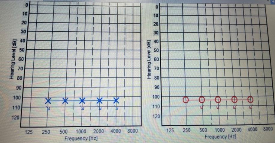 耳声发射图怎么看【华东｜特色诊疗】耳鼻咽喉科：“五种检查”测听力！科学诊断耳背原因_https://www.jmylbn.com_新闻资讯_第7张