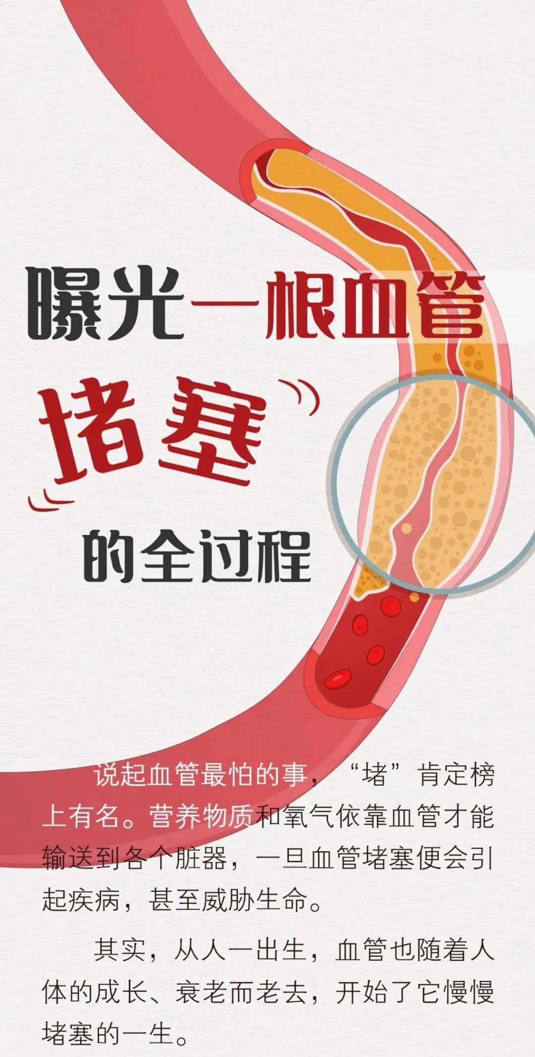 健康曝光一根血管堵塞的全过程