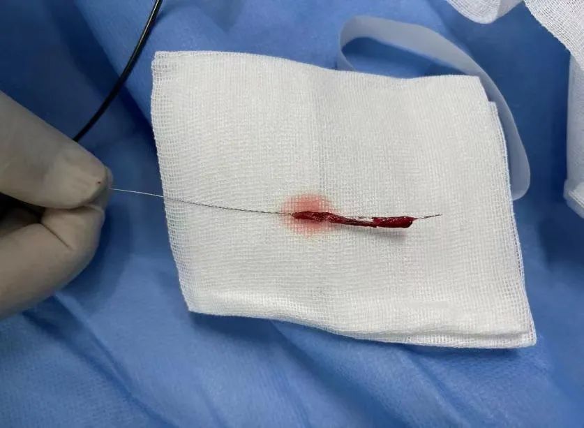 取栓就是与时间赛跑,与生命赛跑