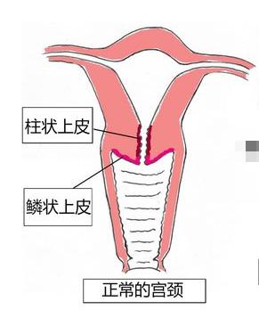 宫颈存在两种上皮细胞,靠近子宫的柱状细胞和靠近阴道的鳞状细胞,双方