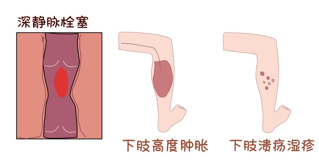 口服避孕药也会危及性命警惕肺栓塞