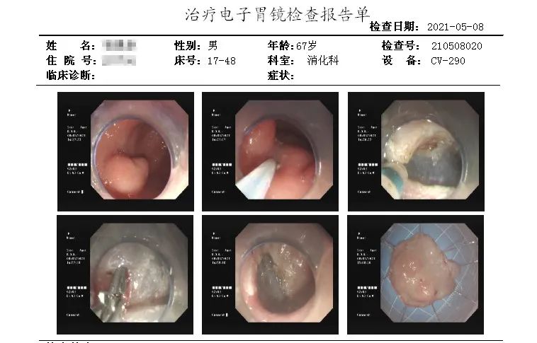 家属沟通后,完善术前评估,为张大爷实施了内镜下胃黏膜下剥离术(esd)