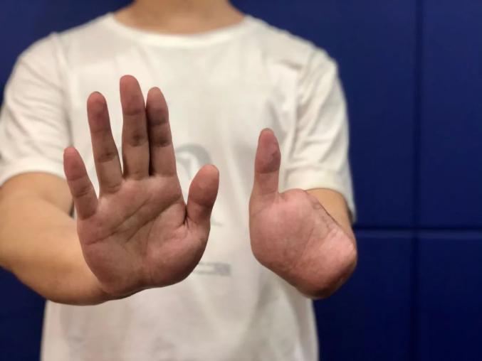 噩梦一小伙去趟境外结果4根手指没了