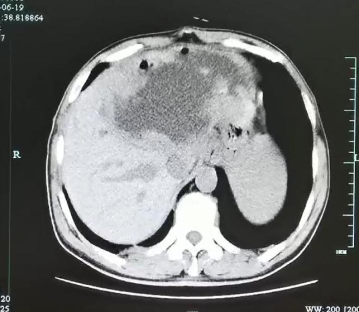 吓傻男子左肝被掏空壁上长满了虫卵只因吃了这种鱼