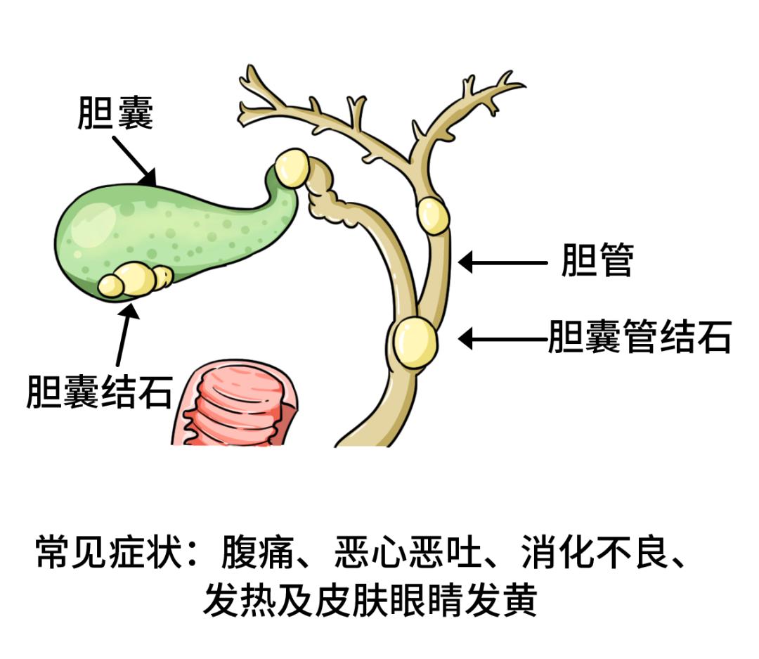 胆囊结石临床表现图片