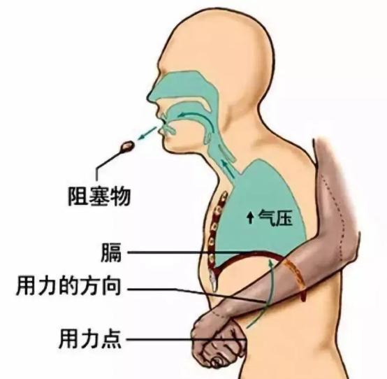 一手掌將嬰兒的後頸部固定,頭部輕度後仰,固定其雙側下頜角,打開氣道