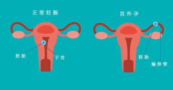 我们知道,正常的胚胎应该长在子宫腔里,而宫外孕,顾名思义,就是没长