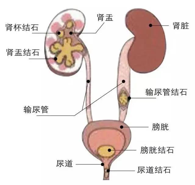 泌尿系结石六大误区