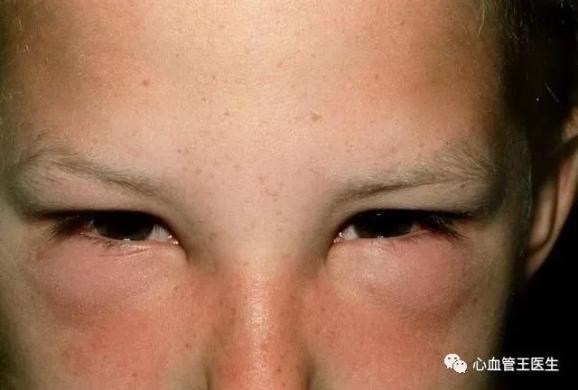 尿液出现这些变化有可能是肾不好的提醒