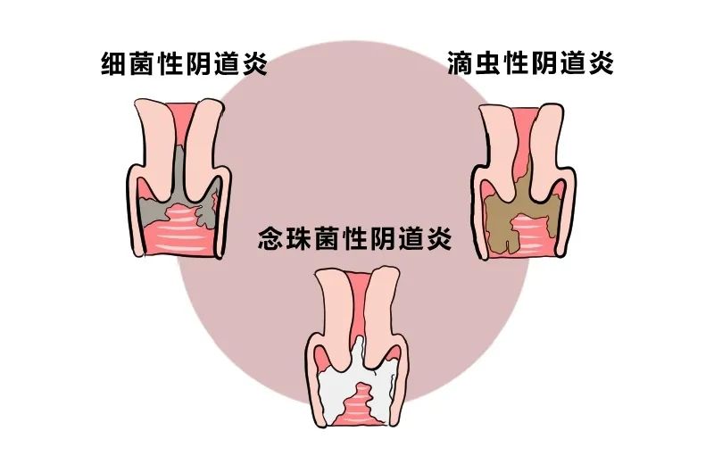 滴虫性阴炎早期图片图片