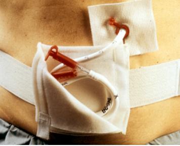 微创又美观的肠内营养方式——经皮内镜下胃造瘘术