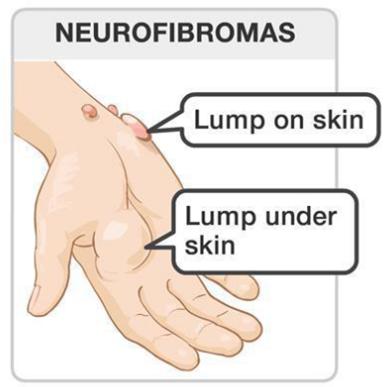 小斑點還是大問題神經纖維瘤這種疾病你瞭解嗎