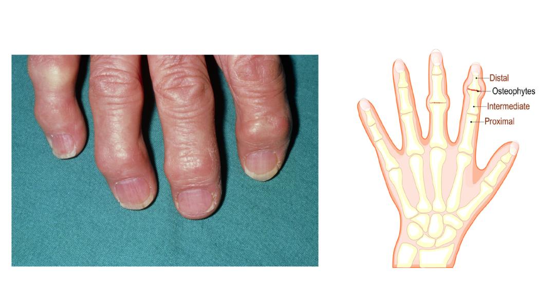 手指骨膜炎的症状图片图片