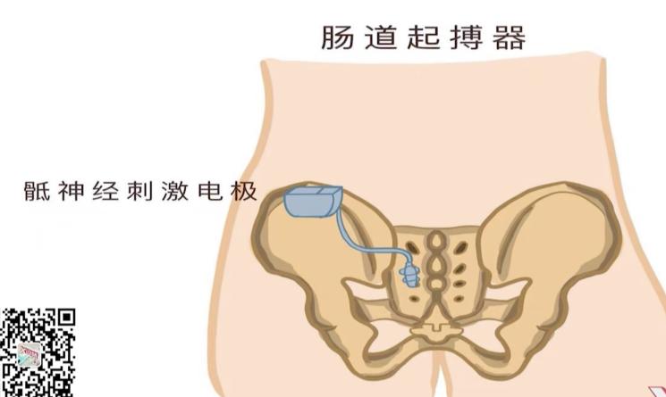 骶神经刺激器图片