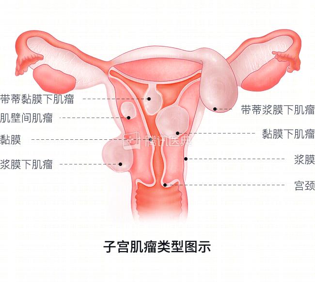 怀孕23周子宫位置图图片