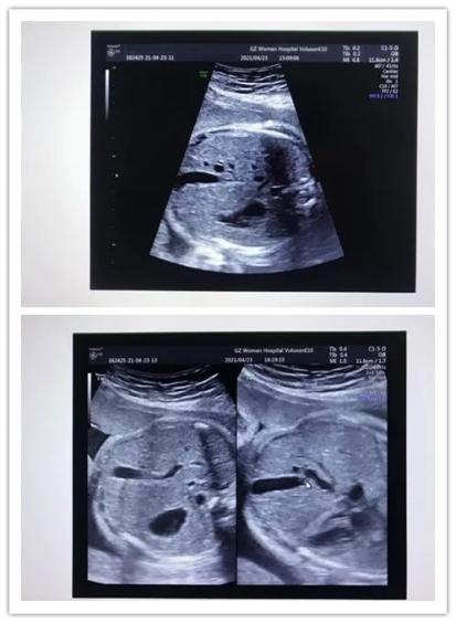 我院超声医学科诊断一例罕见胎儿先天性门体静脉分流