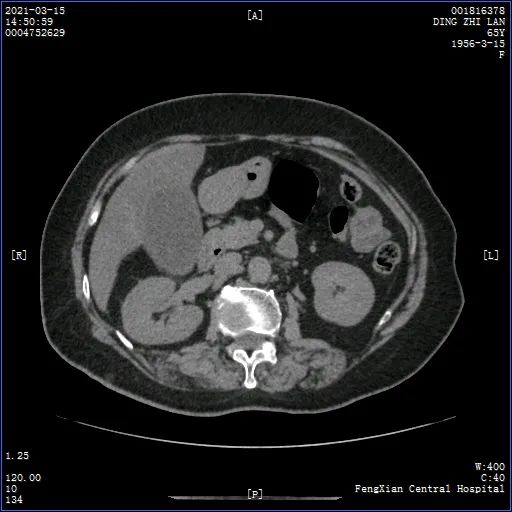 因为上腹部疼痛伴高热2天,丁阿姨被我院急诊外科拟急性胆囊炎后收治