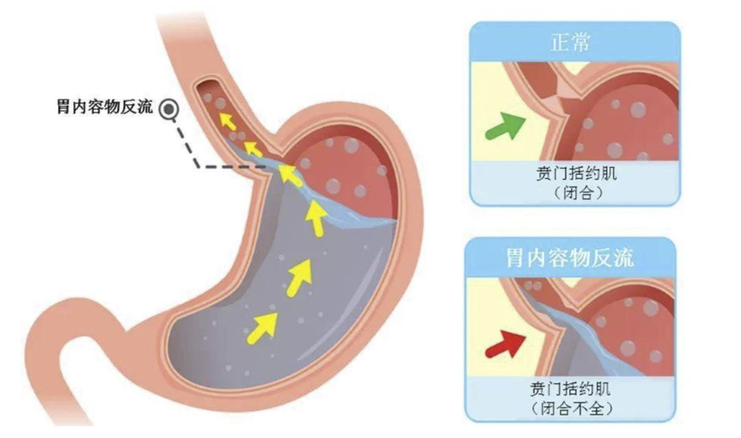 胃食管反流的"杀伤力"真不小,远离这几种食物,胃会感激你的
