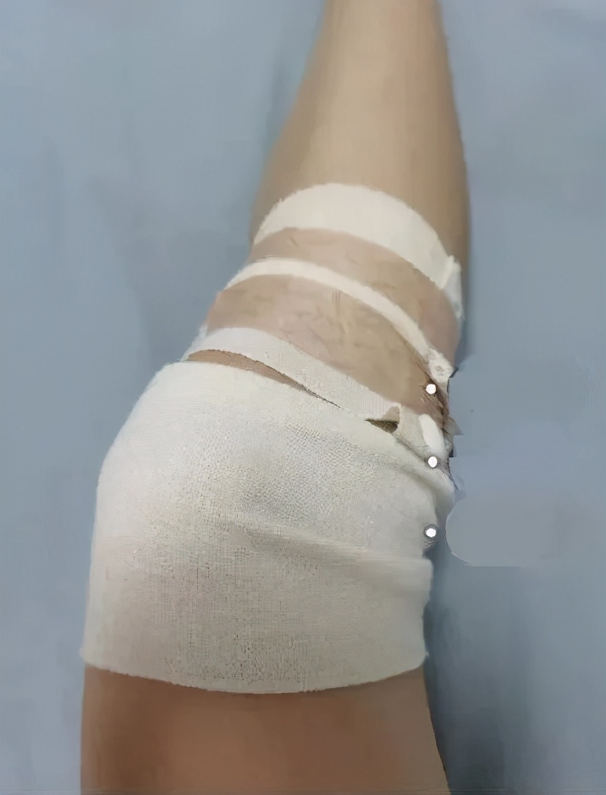 阻断术就是切断小腿一些相对不那么重要的肌肉神经分支让肌肉失去活力