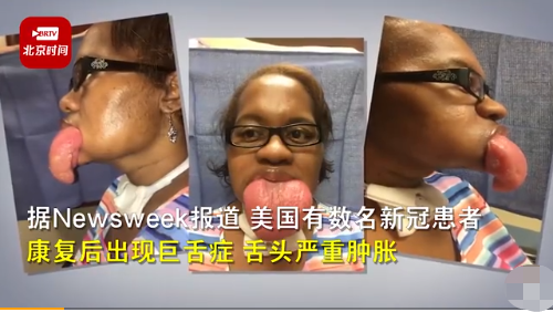 科技早新闻美国新冠康复者出现巨舌症清华成立量子信息班