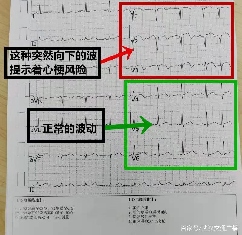 去年10月,他在武汉市肺科医院进行心电图检查时,被医生李维飞发现心脏