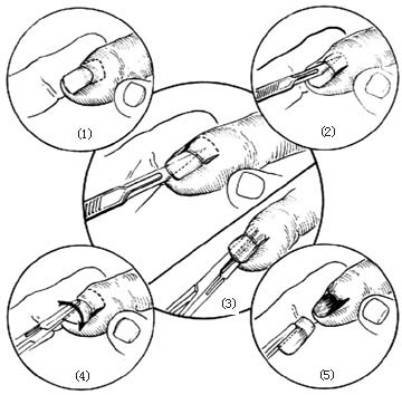 2, 手术切除受累组织:对于嵌甲引起长期发作慢性足趾甲沟炎,较为严重