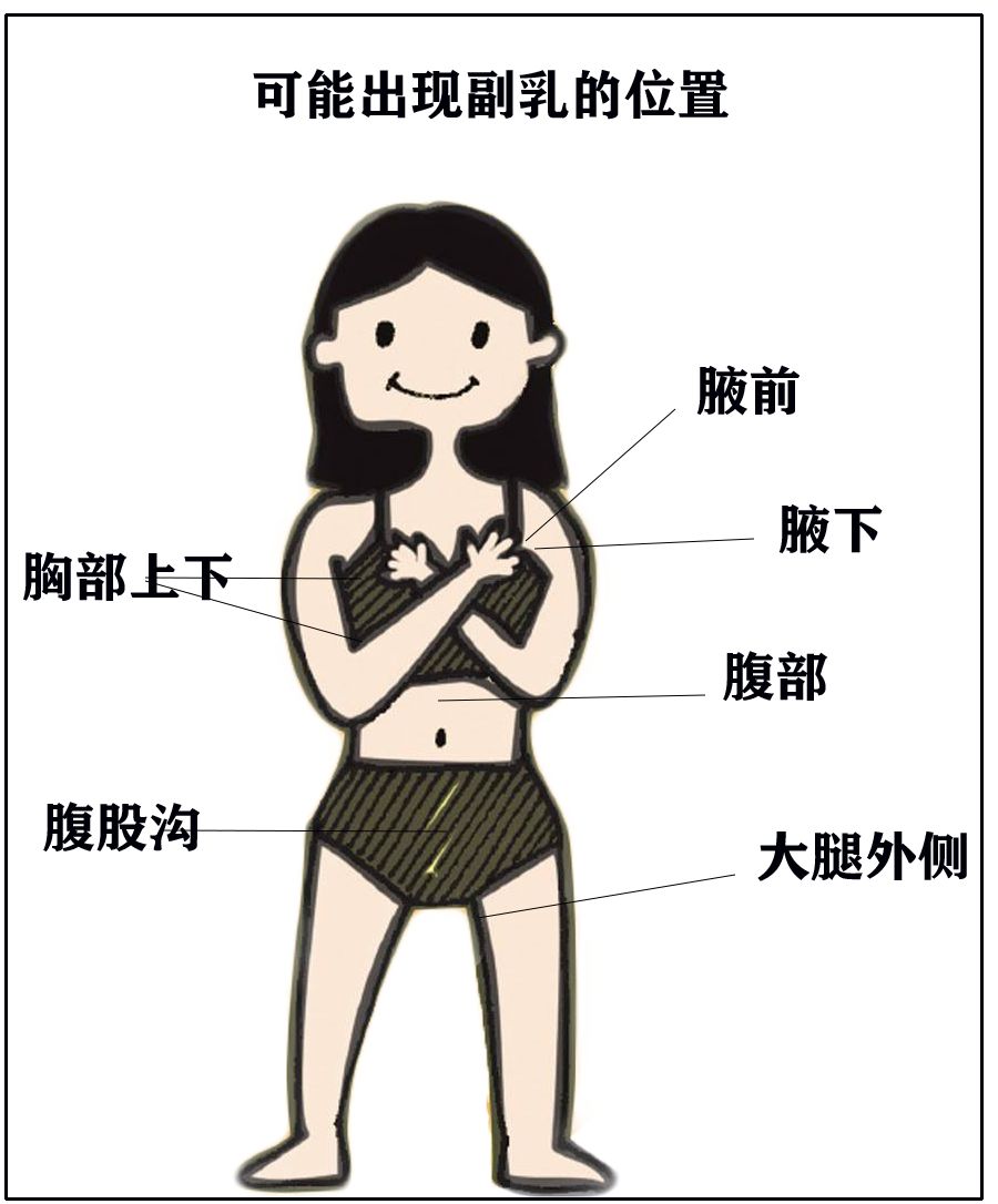 真正的副乳是人體胚胎髮育中退化或者退化不全的