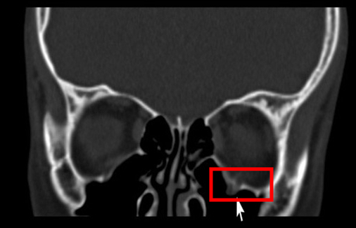 11岁男孩辅导班里与同学相撞意外眼眶骨折齐鲁医院青岛眼科专家紧急