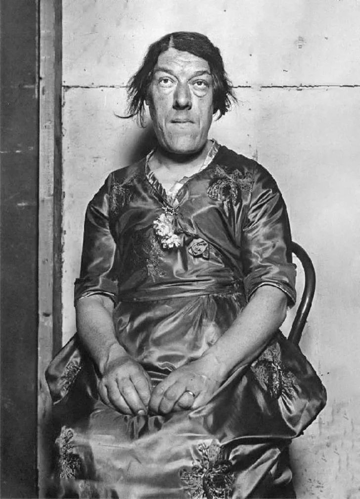 她患上了在当时无法治疗的疾病——肢端肥大症(acromegaly)