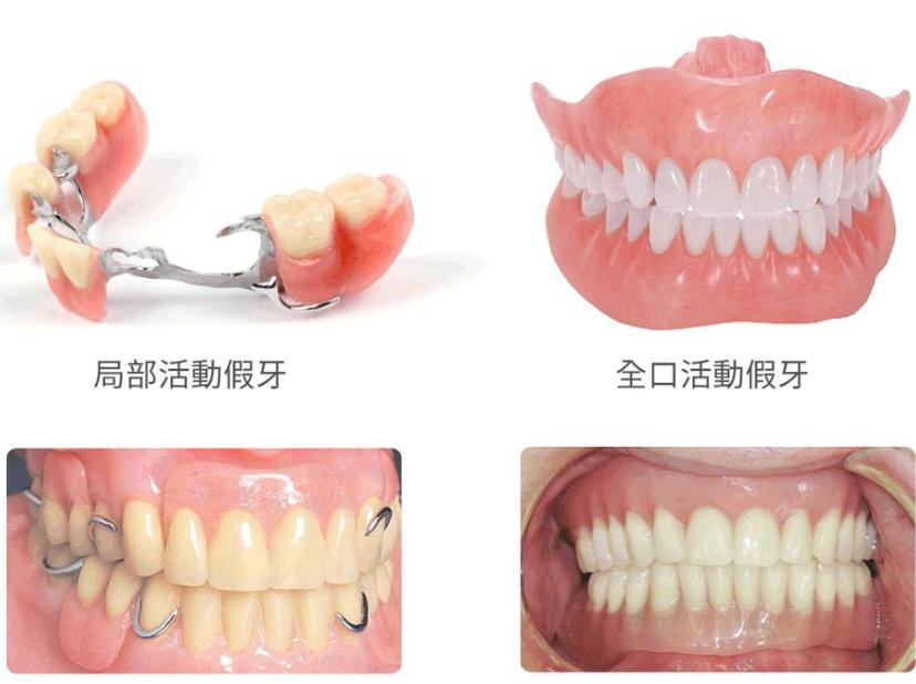 活动义齿有几种类型图片