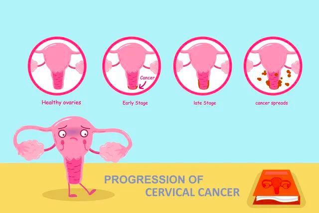 查出hpv阳性是什么意思?一定会得"宫颈癌"?