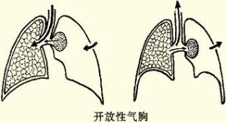 一文带你了解气胸这种会呼吸的痛