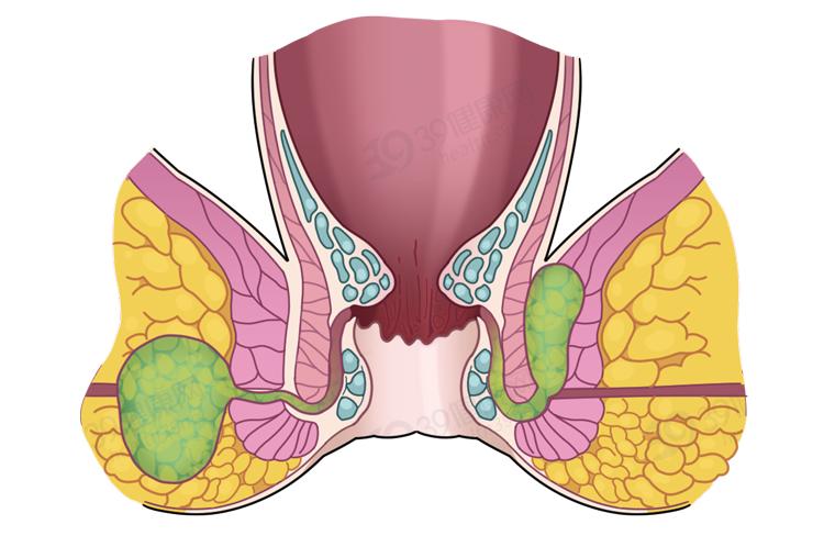 直腸後間隙膿腫肛門直腸周圍膿腫肛周膿腫在肛瘻內口則可摸到小硬結並
