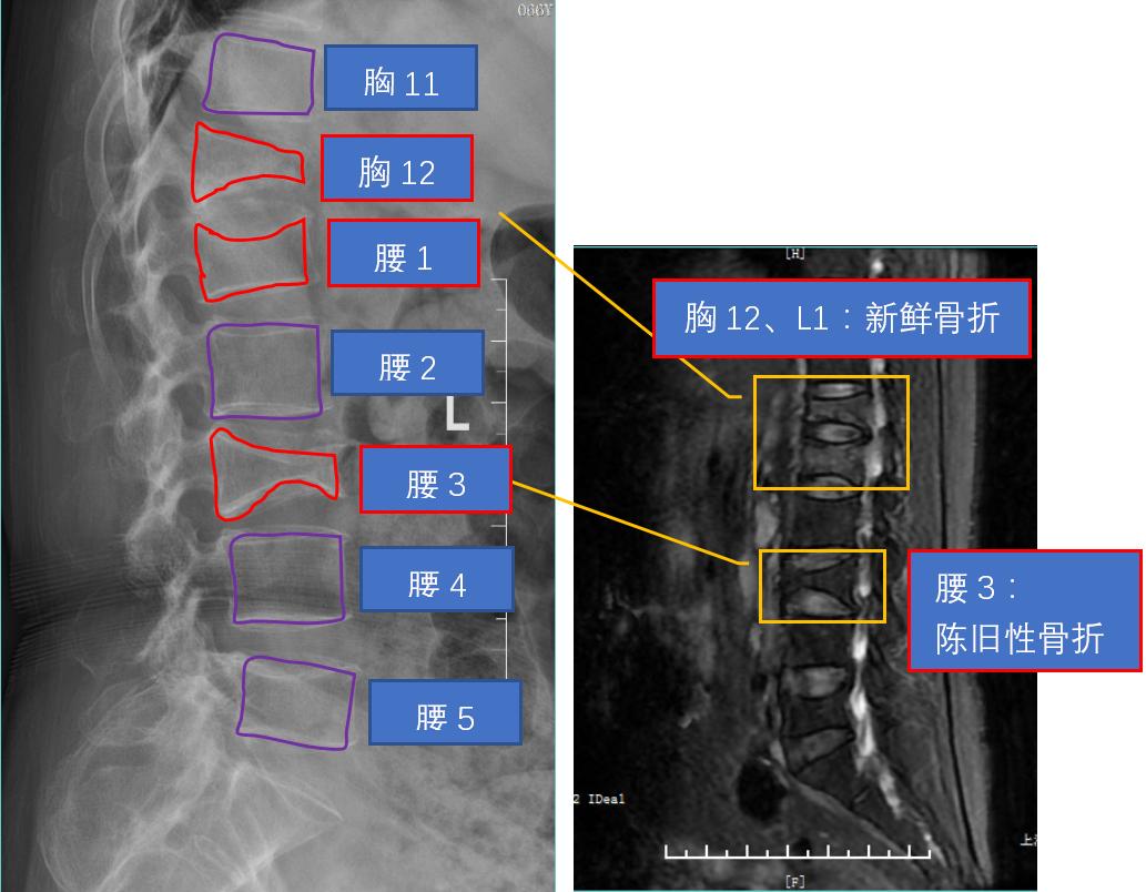 胸12椎位置示意图图片