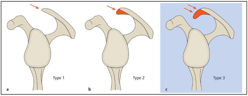 美国肩关节专家bigliani提出三种肩峰形态第三种就是钩状肩峰|科学网